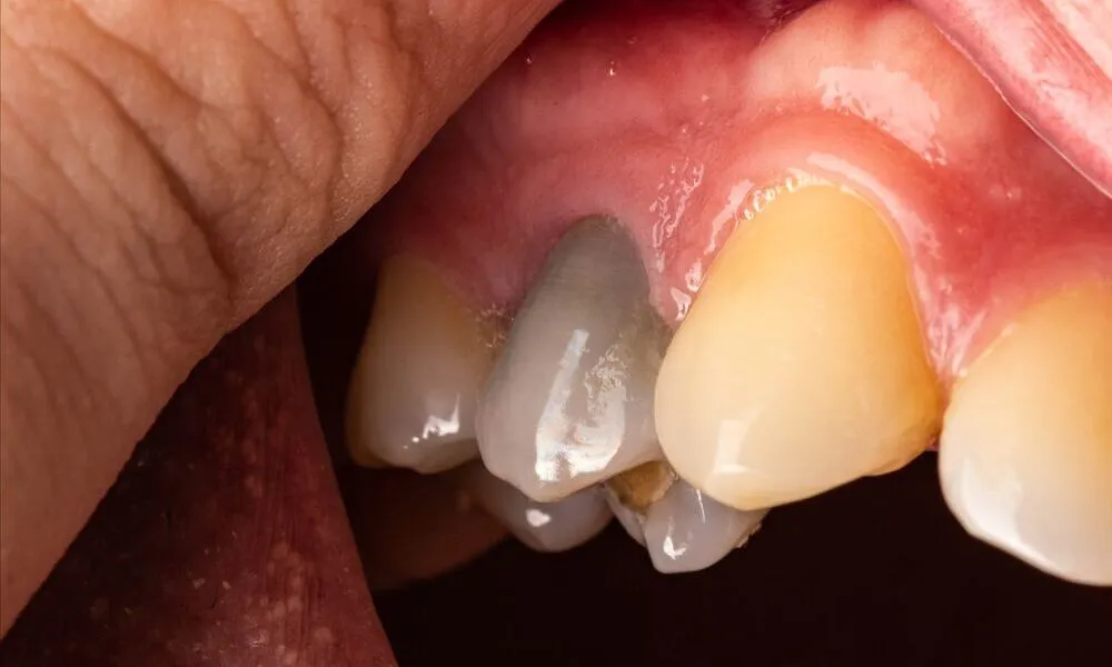 How to Save a Dead Tooth: Causes, Symptoms, and Prevention 3 dead tooth