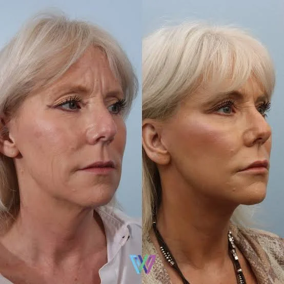 deep plane facelift before after