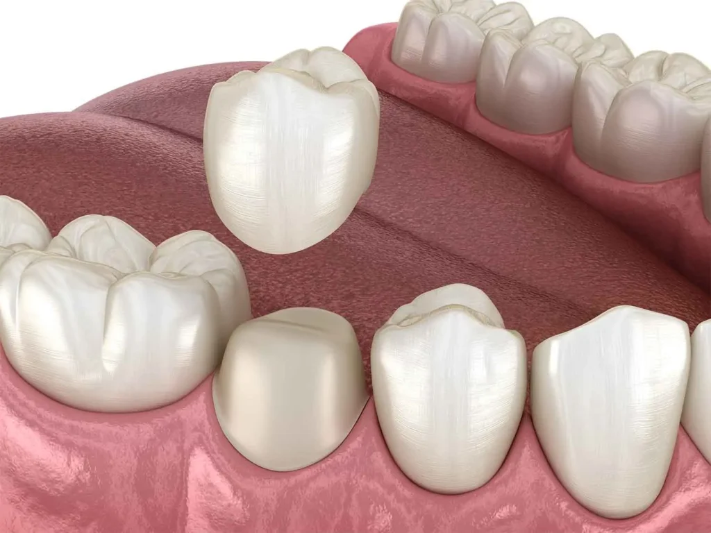 dental crown 3d