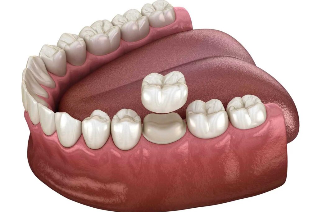 dental crown preparation