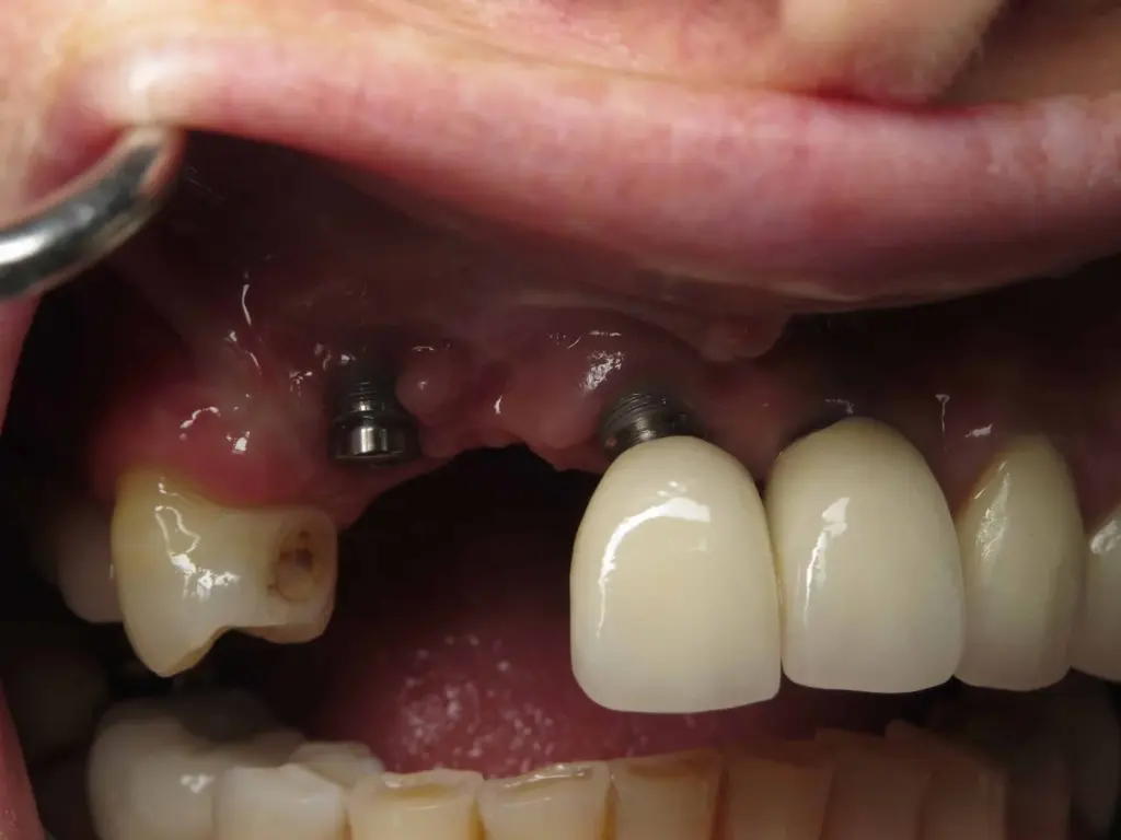 Dental Implant Failure Early Symptoms, Causes & Treatment 2 dental implant failure