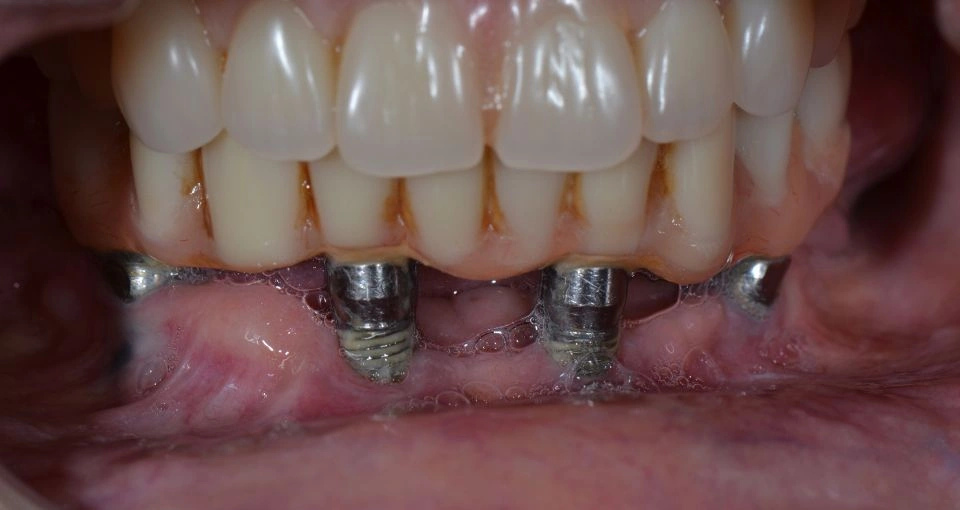 Dental Implant Failure Early Symptoms, Causes & Treatment 3 dental implant failure rate