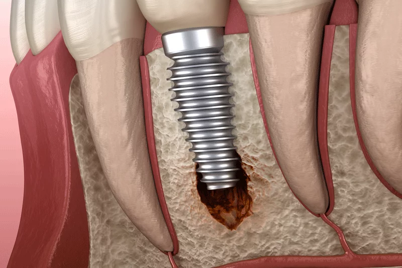 dental implant failure