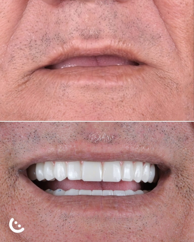 dental implant in turkey before after