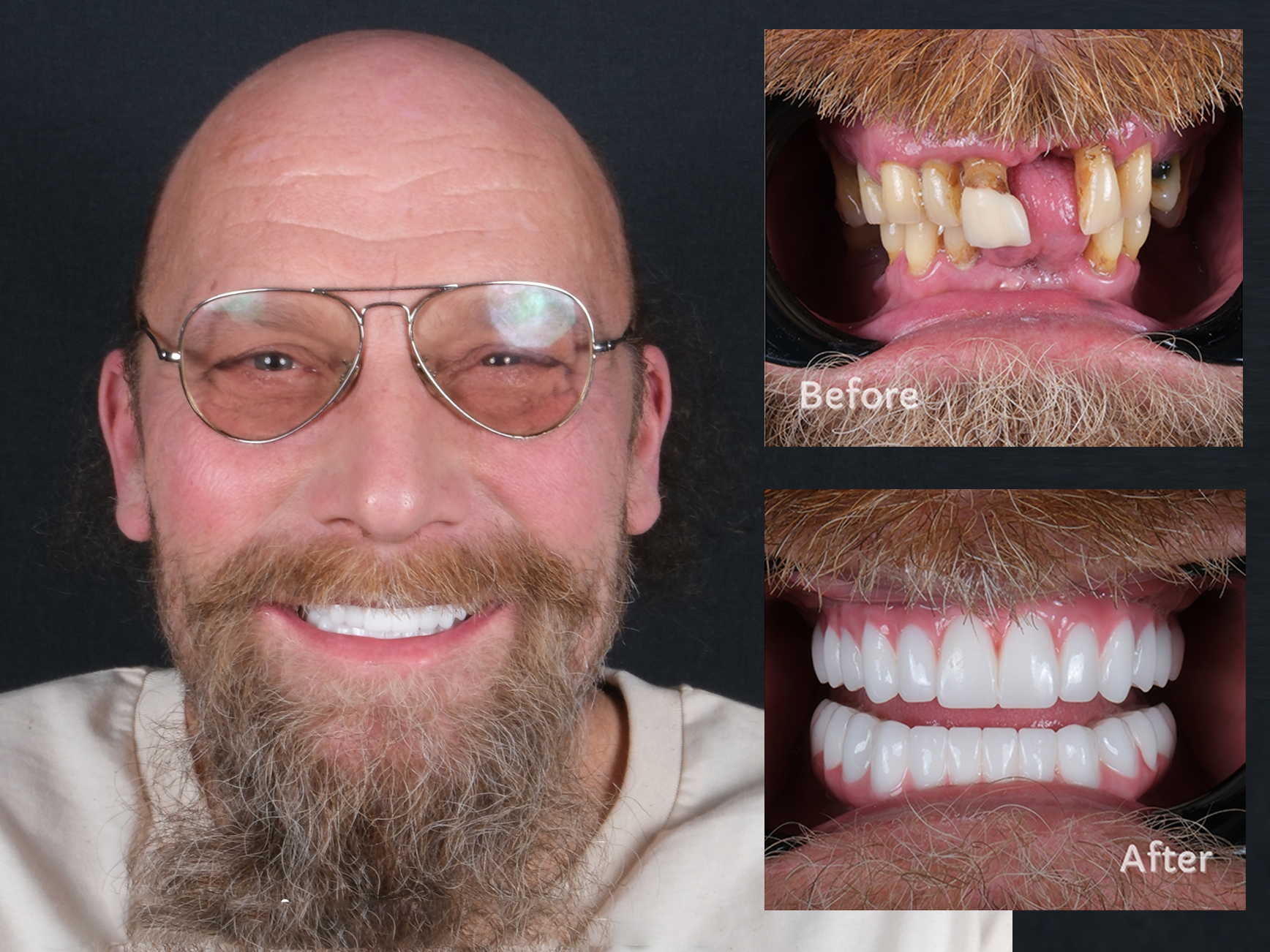 dental implants 1