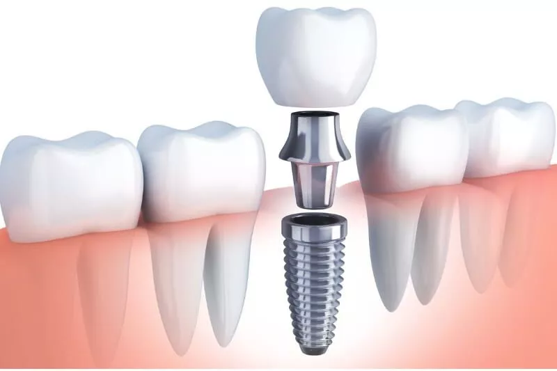 dental implants oral care