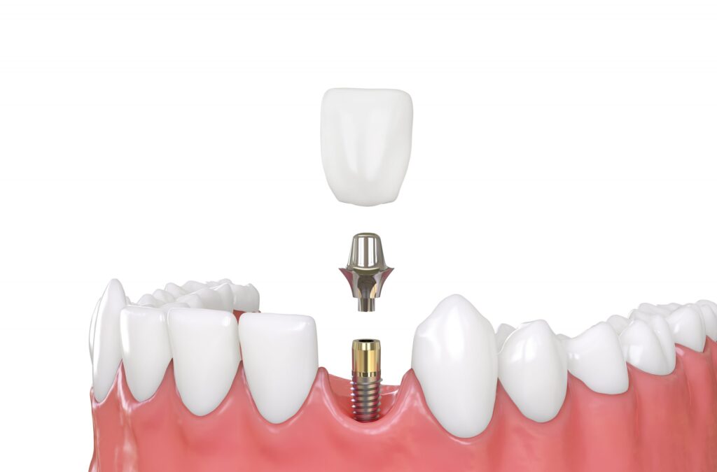 dental implants smile