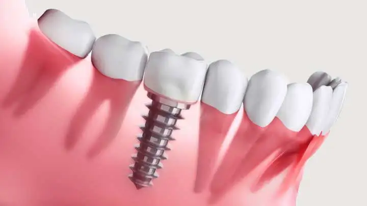 dental implants
