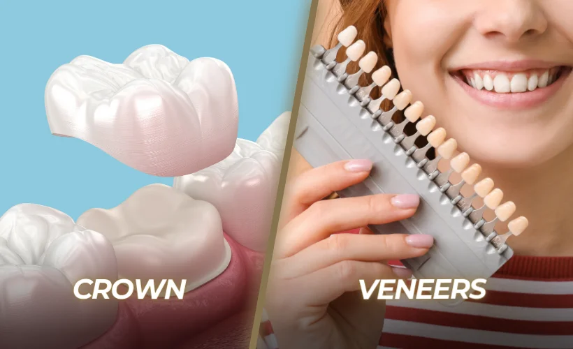 Veneers vs Crowns: Price, Durability, Differences & Pros-Cons