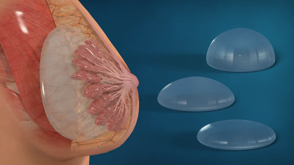Arten von Brustimplantaten: Silikon vs Kochsalz, Formen & Größen 3 different breast implant types