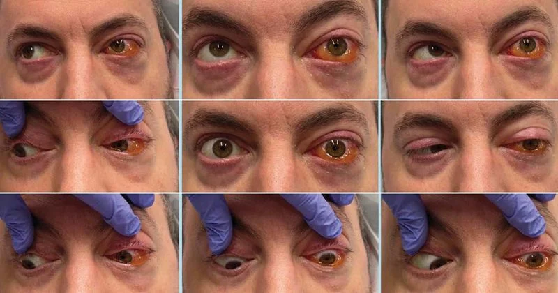 Was sind die Ursachen für Diplopie und wie wird sie behandelt? 2 diplopia causes
