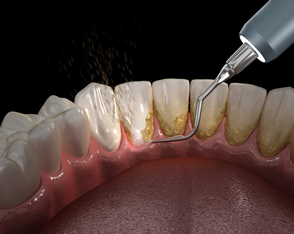 dis tasi temizligi ne siklikla yapilmali