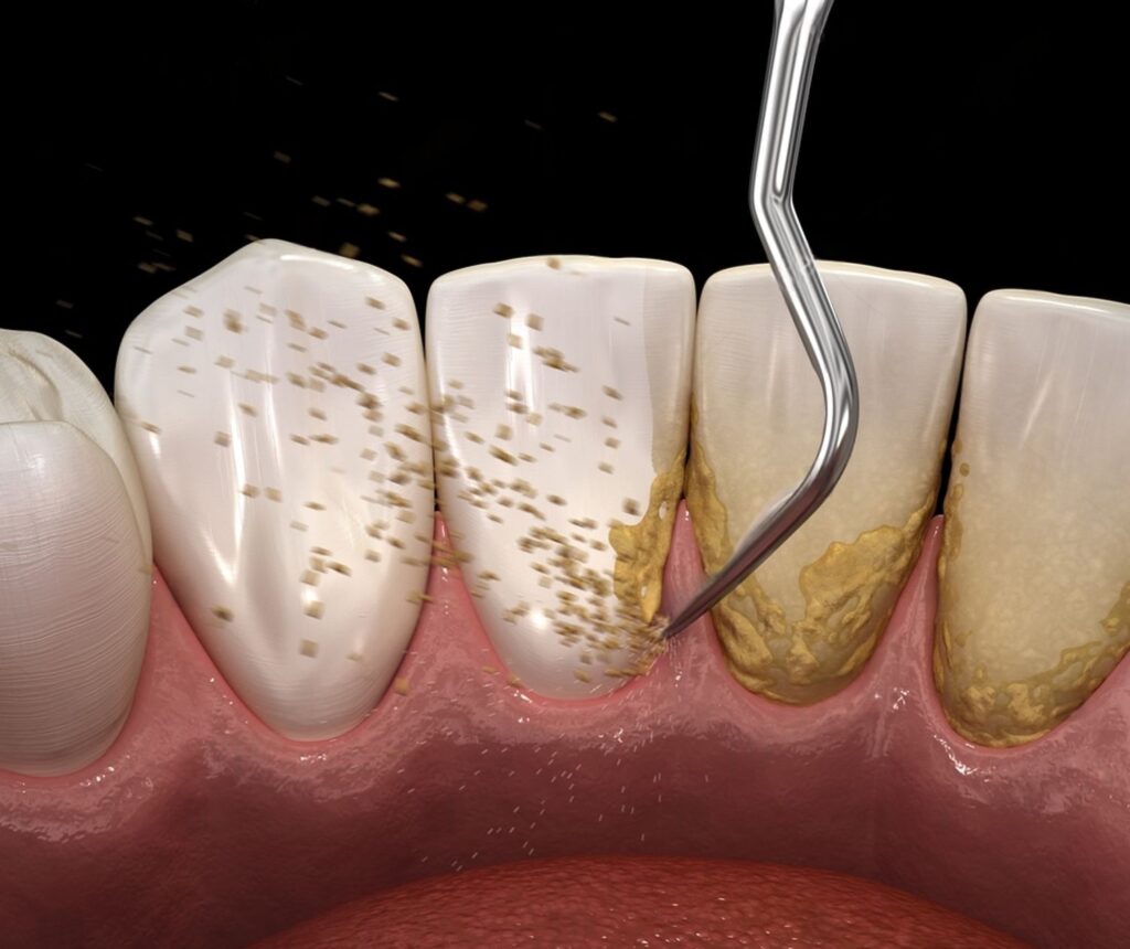 dis tasi temizligi sirasinda agri olur mu