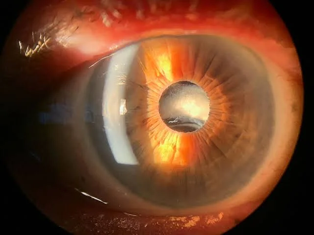Dislocated Intraocular Lens Symptoms, Causes & Treatment 1 dislocated intraocular lens symptoms