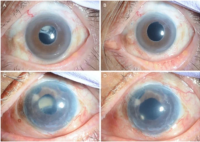 Dislocated Intraocular Lens Symptoms, Causes & Treatment 3 dislocated intraocular lens treatment