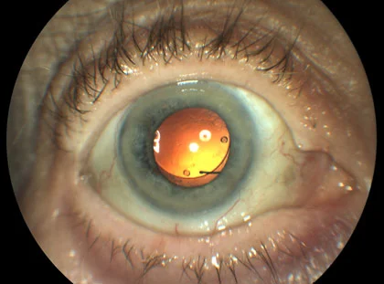Dislocated Intraocular Lens Symptoms, Causes & Treatment 2 dislocated intraocular lens