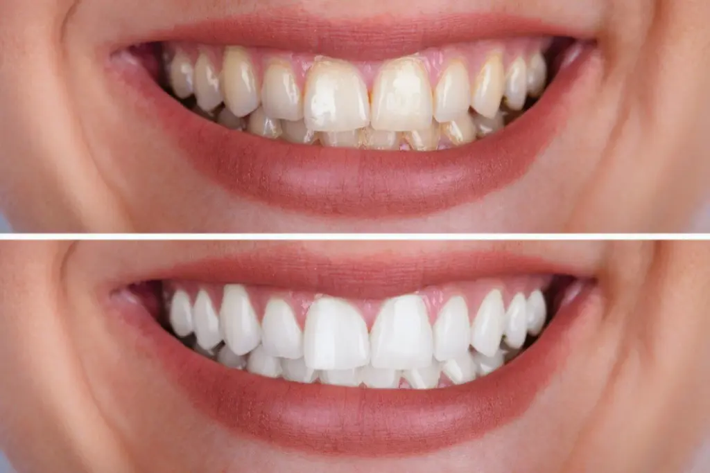 Empfindlichkeit der Zähne nach dem Bleaching: Ursachen & Linderung 2 teeth whitening sensitivity