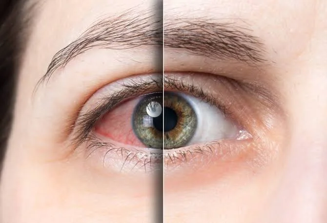 Dry Eyes After LASIK Causes, Remedies & Timeline 1 dry eyes after LASIK causes