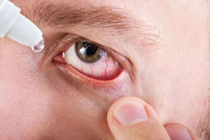 Dry Eyes After LASIK Causes, Remedies & Timeline 3 dry eyes after LASIK treatment