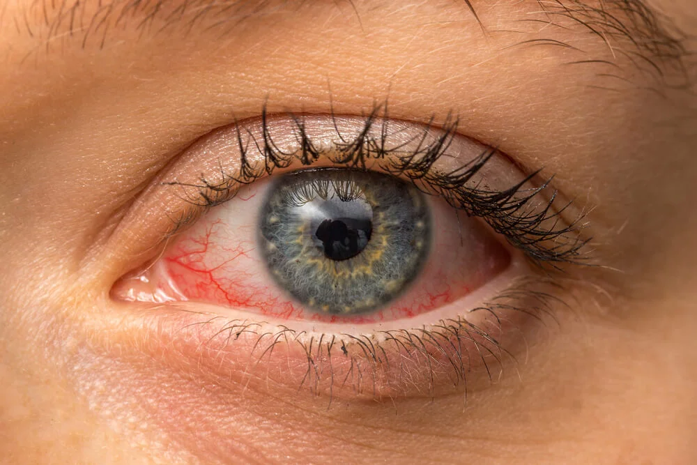 Dry Eyes After LASIK Causes, Remedies & Timeline 2 dry eyes after LASIK