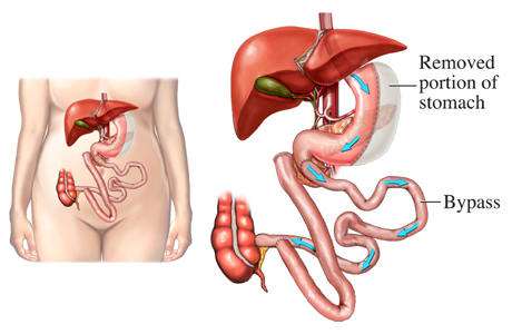 duodenal switch for revisions