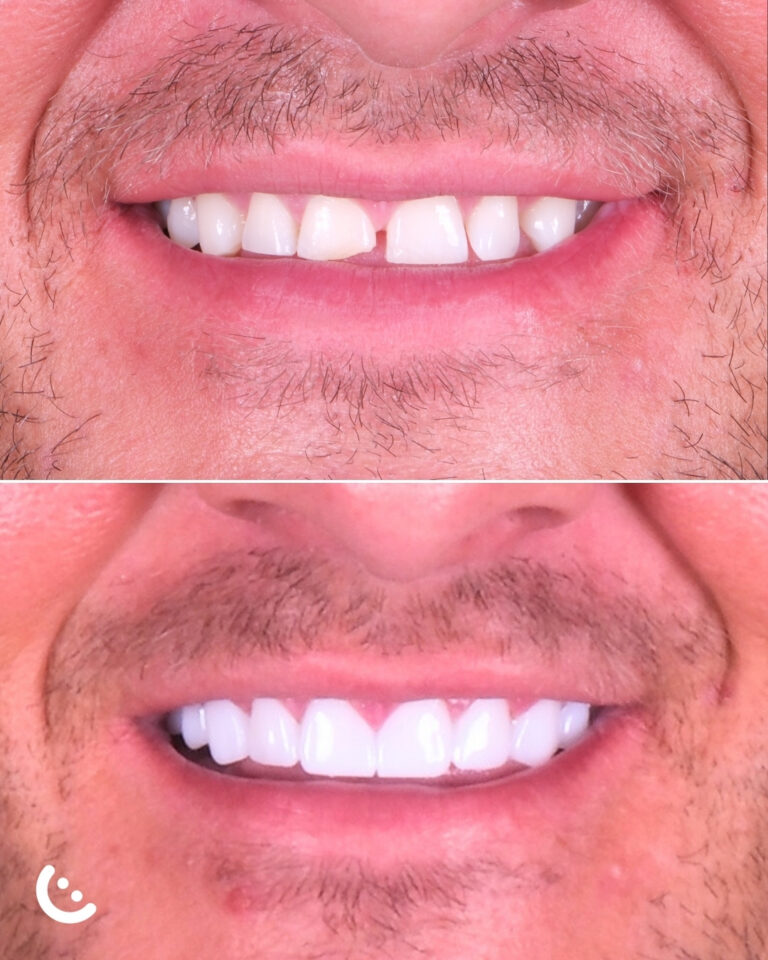 e max crown in turkey before after