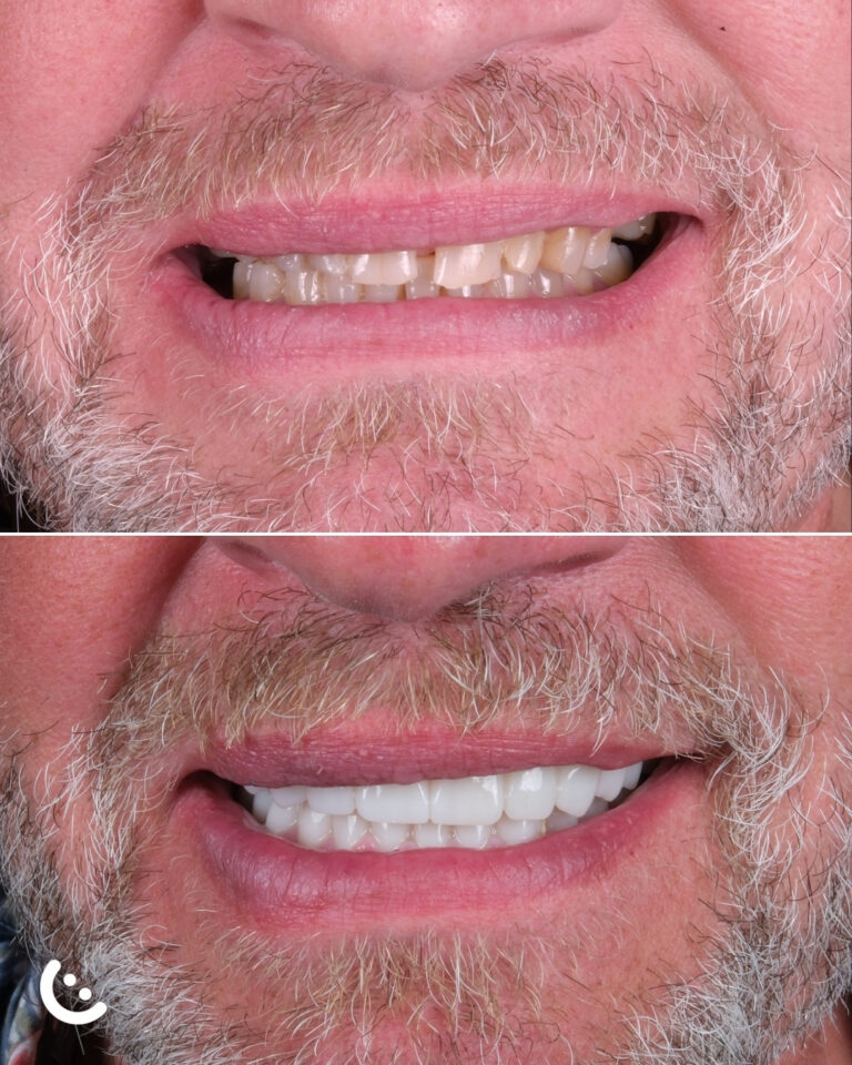 e max crown turkey before after