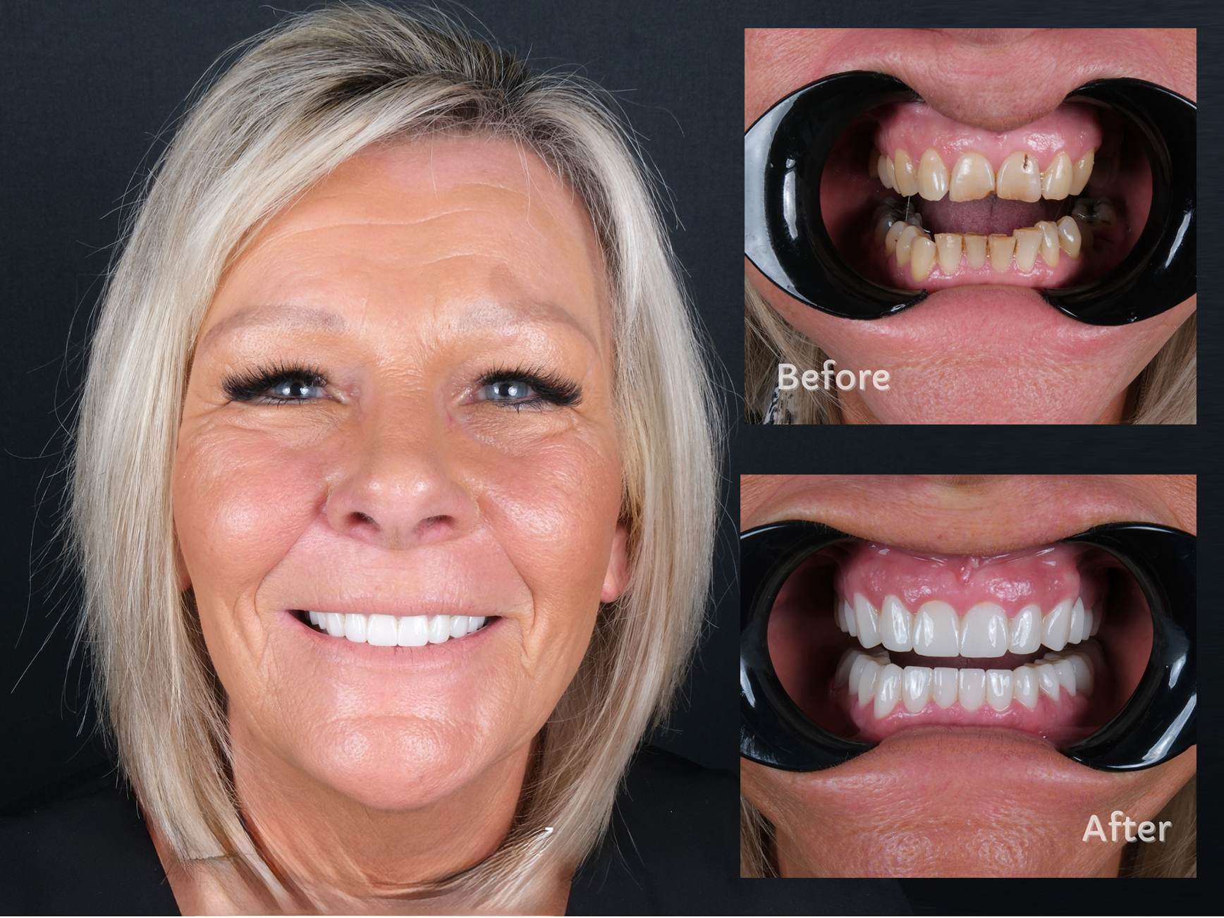 emax crowns