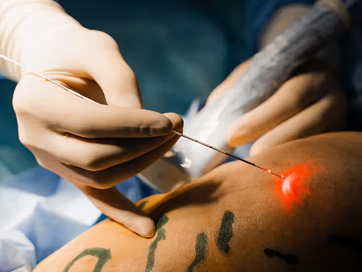 endovenous laser ablation 