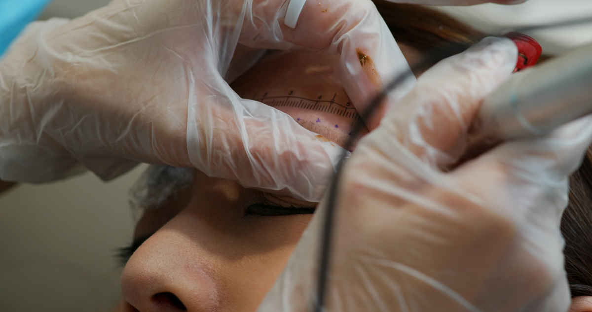 eyebrow transplant 1