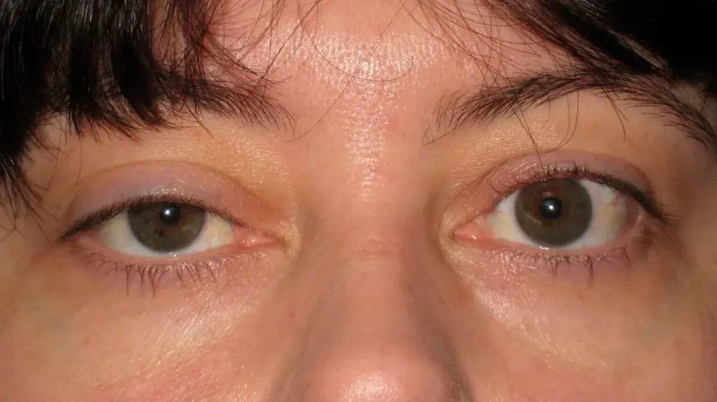 eyelid dropped
