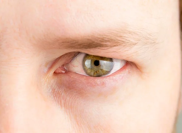 eyelid dropped causes