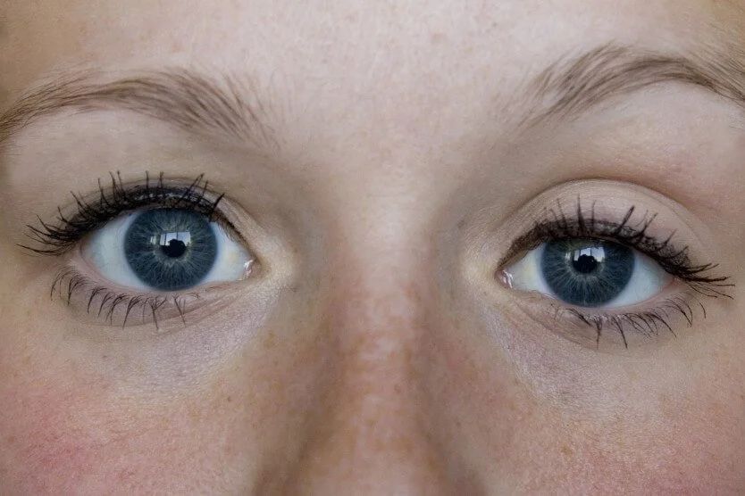 eyelid dropped