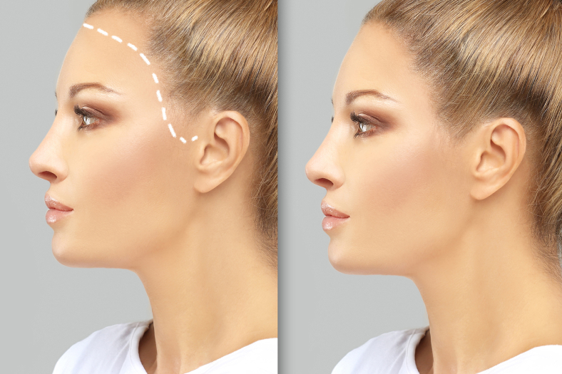 female hair transplant journey