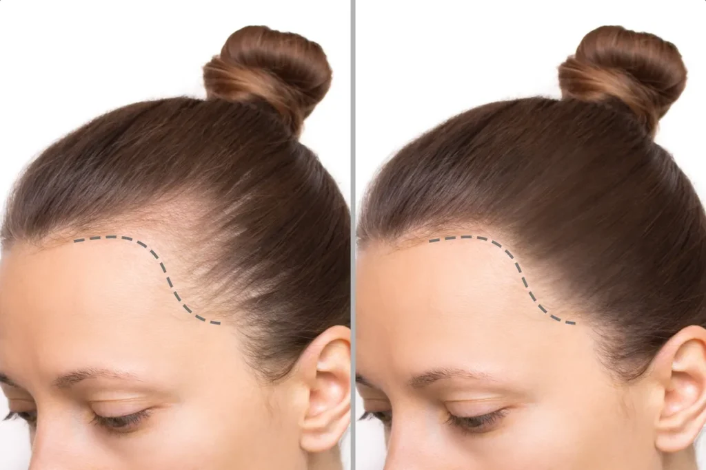 female hair transplant procedures