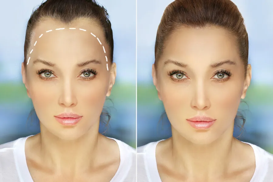 female hair transplant