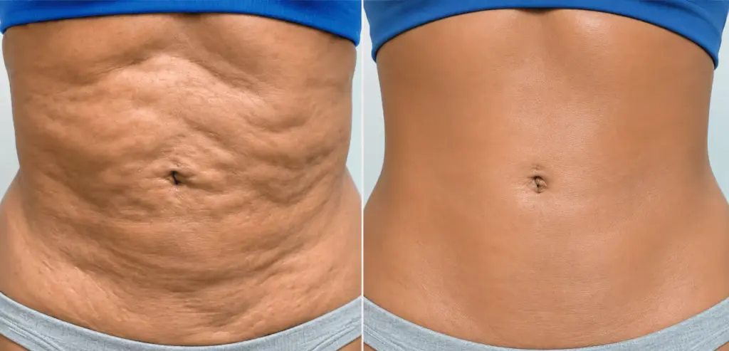 Fibrosis After Liposuction: Causes, Symptoms, Treatment 2 fibrosis after liposuction treatment