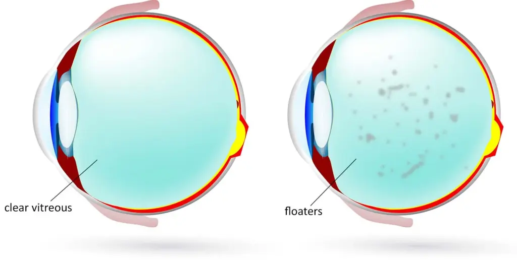 floaters in eyes