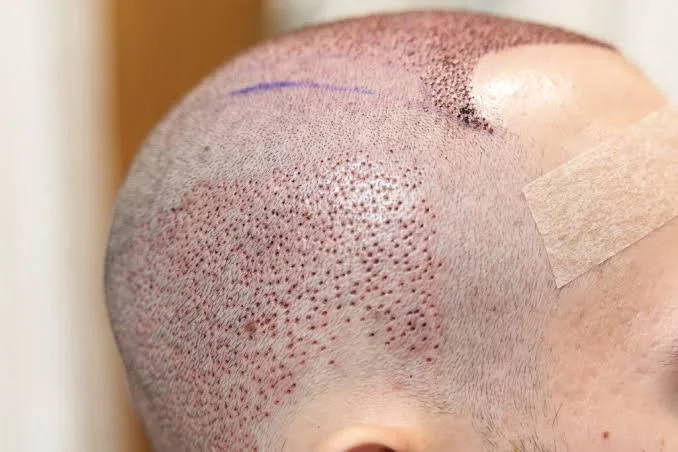 Folliculitis After Hair Transplant Causes, Symptoms & Treatment 2 folliculitis after hair transplant treatment