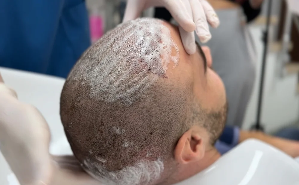 folliculitis after hair transplant