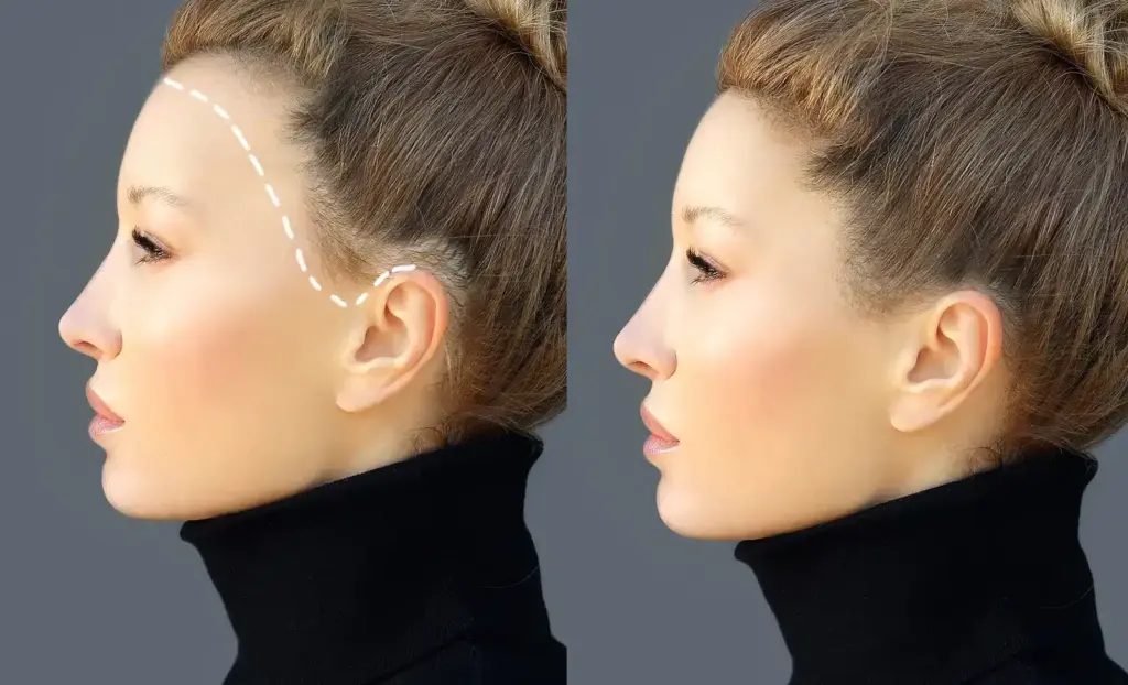 forehead reduction surgery