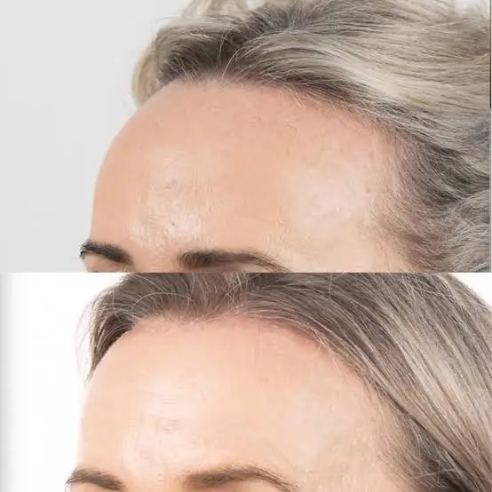 forehead reduction surgery before after