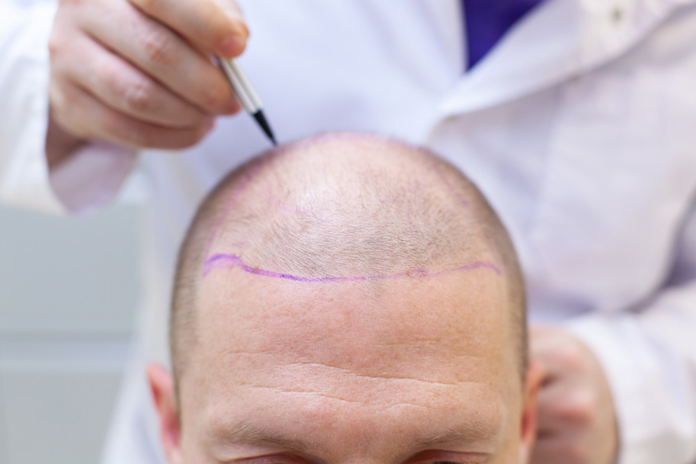 fue vs dhi hair transplant