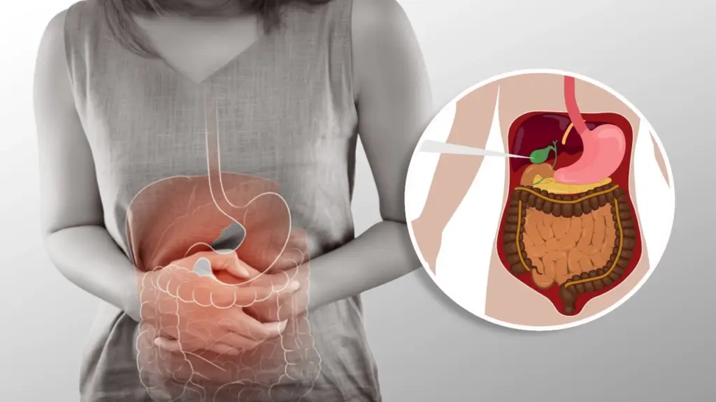 gallstones after bariatric surgery