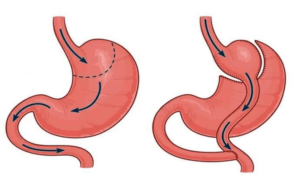 gastric sleeve vs gastric bypass surgery