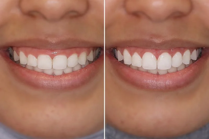 Gingivectomy: Laser Gum Contouring, Procedure, Recovery & Cost 3 gingivectomy
