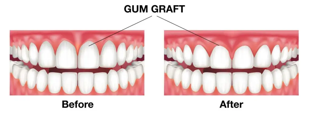 gum graft before after
