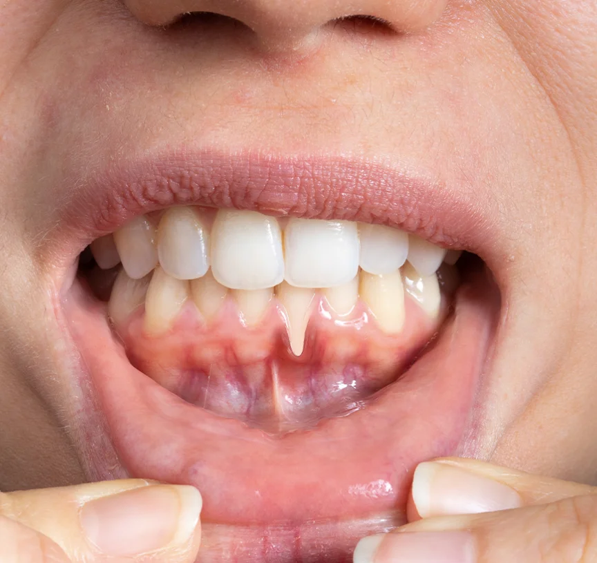 gum graft cost