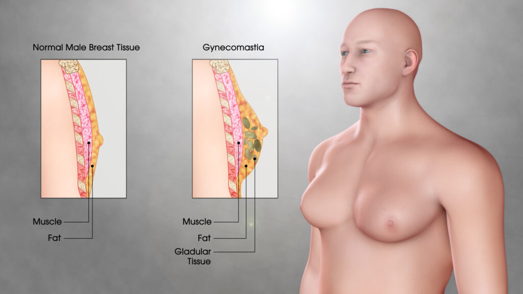 gynecomastia