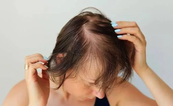 Haarausfall nach bariatrischer Operation Vorbeugen & Therapie 3 hair loss after bariatric surgery